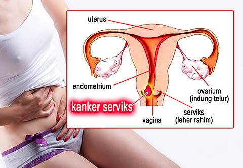 Obat Alternatif Kanker Serviks Terbaik 100% Alami Manjur