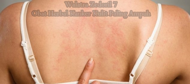 Obat Herbal Kanker Kulit Paling Ampuh