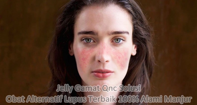 Obat Alternatif Lupus Terbaik 100% Alami Manjur